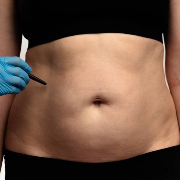 Body Lift Surgery
