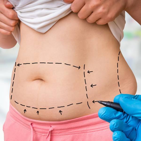 Laser-Assisted Liposuction