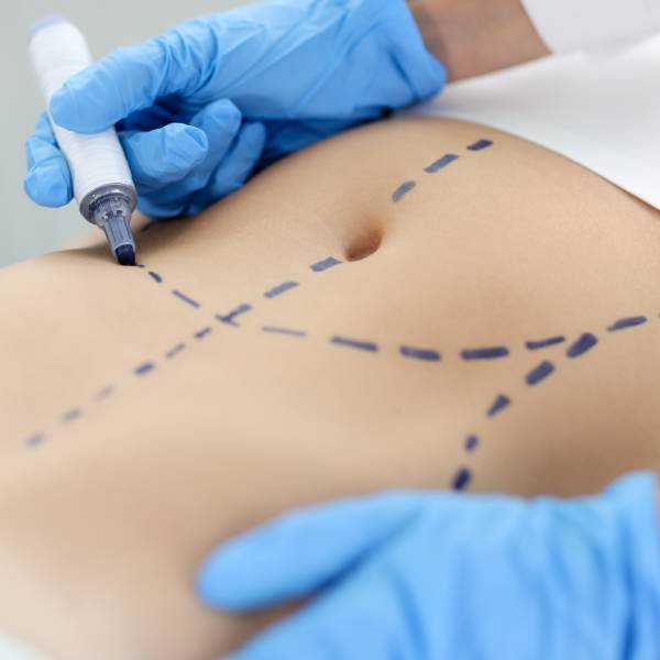 Abdominoplasty