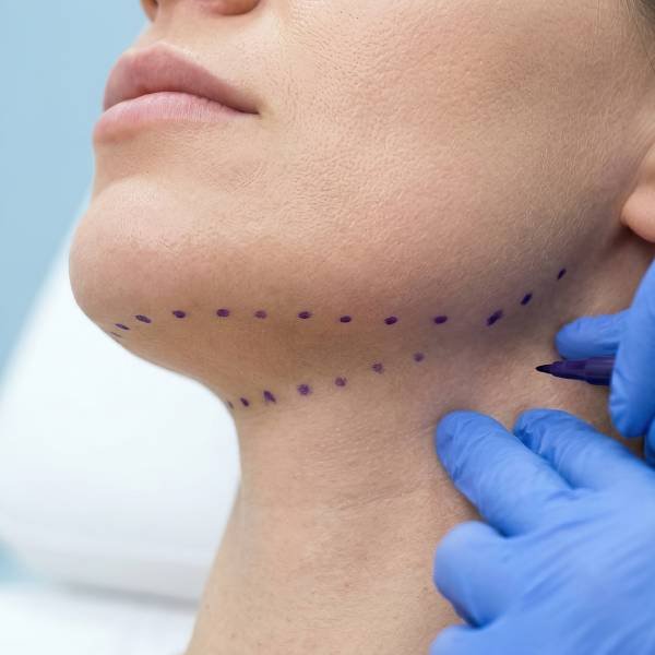 Deoxycholic Acid Double Chin Reduction